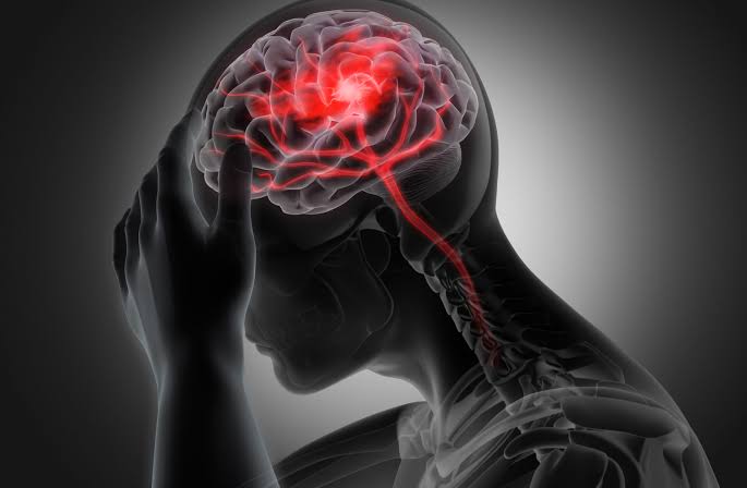RD registra 60 casos diarios de ACV y hasta 4,000 muertes al año, según neurocirujano